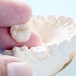 Closeup of dental crown restoration