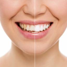 Before and after teeth bleaching or whitening treatment. Close-up of young female's smile.
